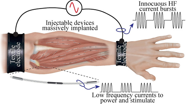 Der Grundaufbau des intelligenten drahtlosen Netzwerks aus Sensoren und Aktoren. Es besteht aus injizierten Elektroden, externen Textilelektroden und Controllern. © Department of Information and Communications Technologies, Universitat Pompeu Fabra, 08018, Barcelona, Spain / Working principle of the intelligent wireless network of sensors and actuators consisting of injected electrodes and external textile electrodes and controllers. © Department of Information and Communications Technologies, Universitat Pompeu Fabra, 08018, Barcelona, Spain