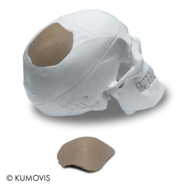 kumovis_cranial_implant