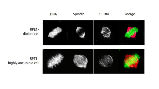 Teilung einer normalen Zelle (oben) und einer Zelle mit abnormal hoher Anzahl an Chromosomen (unten). (v.l.n.r.): DNA, mitotische Spindelstruktur, Anwesenheit des KIF18A-Proteins sowie alles in einem (DNA grün, Spindel rot). Maßstab (weiß): 10 Mikrometer. (Sara Bernhard, TU Kaiserslautern)