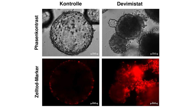 Darmtumor-Organoide nach Behandlung mit Devimistat (rechts) sowie ohne Behandlung (links). Dargestellt sind die Tumororganoide im Phasenkontrast und nach Färbung mit einem roten Zelltodmarker. © Jörg Fahrer, TU Kaiserslautern