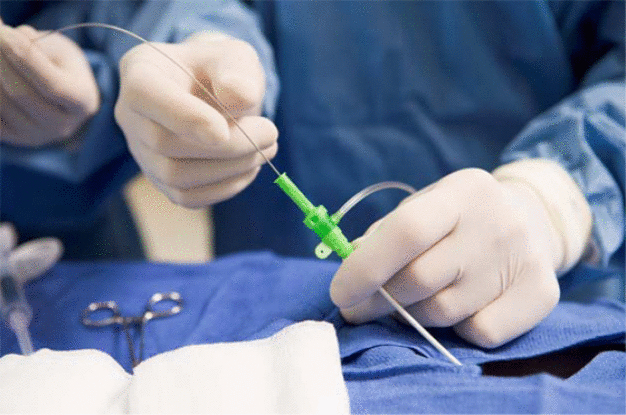 Auch kleinere medizinische Produkte, wie hier Führungsdrähte, können mit den neuen LPW-Technologien dicht gepackt und wirtschaftlich gereinigt werden. (Foto: iStock) Auch kleinere medizinische Produkte, wie hier Führungsdrähte, können mit den neuen LPW-Technologien dicht gepackt und wirtschaftlich gereinigt werden. (Foto: iStock)