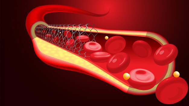 Stents werden eingesetzt, um Gefäße wieder zu öffnen bzw. offen zu halten. Bei ihrer Produktion sind entsprechend der MDR sehr hohe Anforderungen an die Prozess- und Produktsicherheit sowie an das Qualitätsmanagement einzuhalten. (Bildquelle: Freepik - peakanucha) / Stents are used to reopen vessels or keep them open. Very high process and product safety and quality management requirements must be met during their production in accordance with the MDR. (Image source: Freepik, peakanucha) 